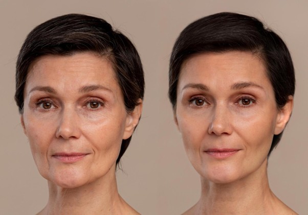 Before and after results of a beauty treatment example
